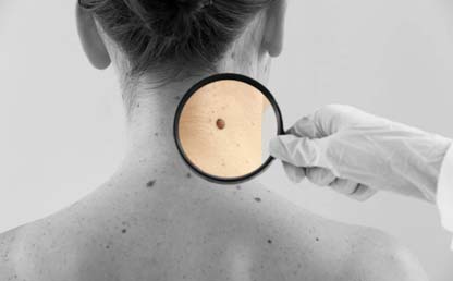 Una lupa sobre el lunar en la espalada de una mujer. 
