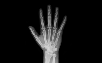 Radiografía de mano 